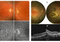 Hypotrichosis with Juvenile Macular Dystrophy